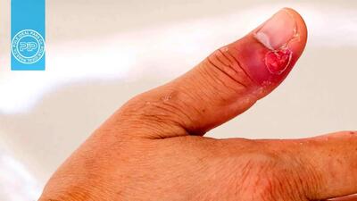 هرپتیک ویتلو کابوسی برای نوک انگشتان / این دشمن پنهان را چگونه درمان کنید؟