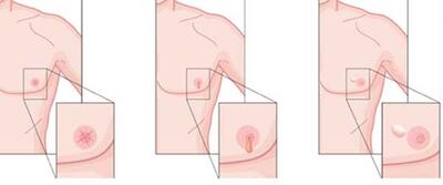 آخرین روش برای پیشگیری از سرطان پستان
