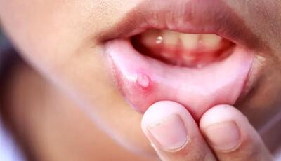 درمان افت دهان به صورت طبیعی و شیمیایی: روش‌های مؤثر برای مقابله با بیماری و تسکین علائم