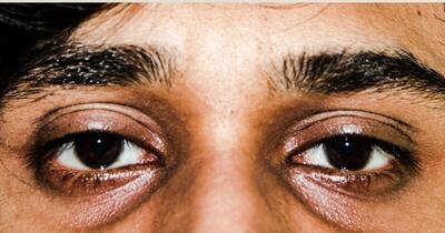 سیاهی دور چشم کمبود چه ویتامینی است؟