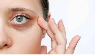 سیاهی دور چشم نشانه کمبود چه ویتامینی است؟