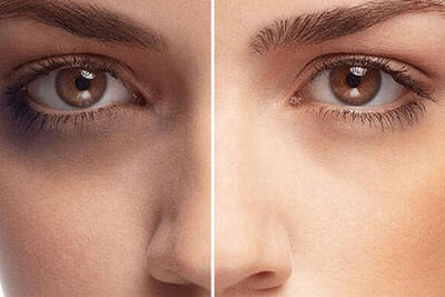 سیاهی دور چشم نشانه کمبود چه ویتامینی است؟ | ویتامین‌های مؤثر در کاهش سیاهی دور چشم