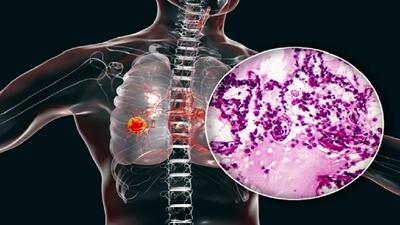 سرطان ریه: عوامل خطر و روش‌های کاهش احتمال ابتلا