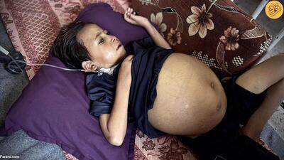 (تصاویر) شکم غیرعادی کودک فلسطینی که بسیار بزرگ است