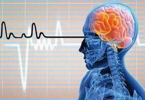 روزانه حدود ۵۰۰ نفر دچار سکته مغزی می‌شوند/سردرد شایعترین علت مراجعه به درمانگاه‌ها