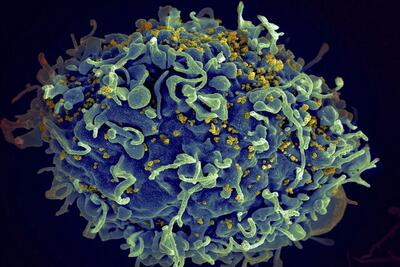 نجات هفتمین نفر در جهان ازبیماری ایدز