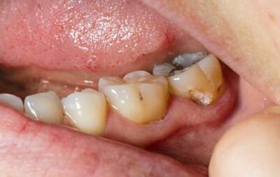 عامل اصلی پوسیدگی دندان ها این باکتری است