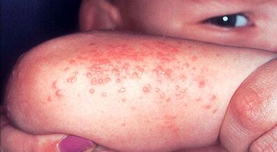 بی توجهی به  درمان عفونت های پوستی در تابستان به سرطان پوست منجر می شود / از اشیاء شخصی مشترک  استفاده نکنید